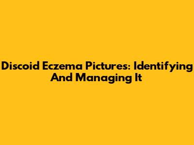 Discoid Eczema Pictures: Identifying And Managing It